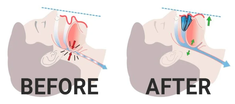 ZQuiet Mouthpiece Before and After